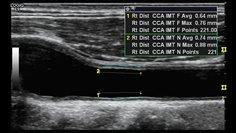 動脈硬化のエコー画面