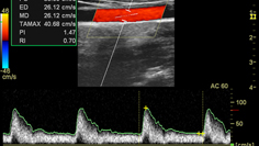 動脈硬化のエコー画面