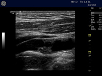 動脈硬化のエコー画面