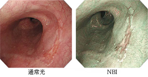 NBI内視鏡システムでの映像と通常光での映像との比較