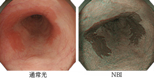 NBI内視鏡システムでの映像と通常光での映像との比較