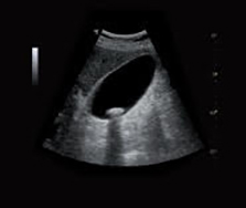 腹部超音波検査イメージ