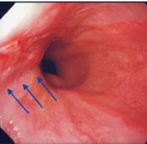 炎症が見られる食道・胃接合部