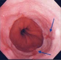 炎症が見られる食道・胃接合部