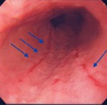 炎症が見られる食道・胃接合部